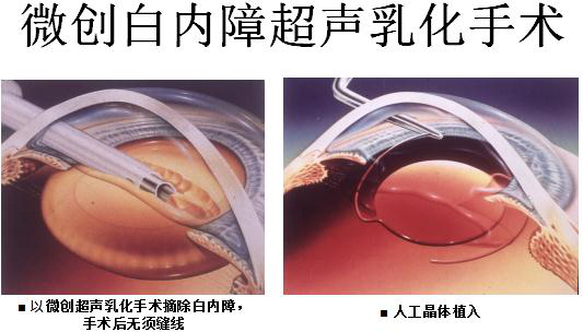 屈光矫正