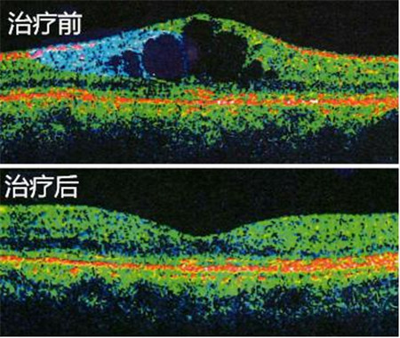 玻璃体视网膜