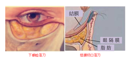 眼眶病