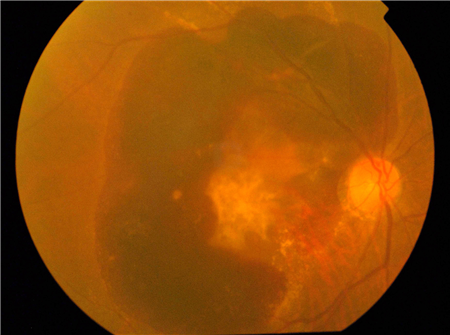 玻璃体视网膜,希玛瑞视眼科,上海眼科医院