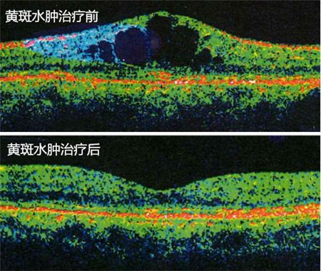 玻璃体视网膜