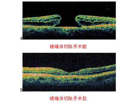 玻璃体视网膜