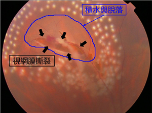 玻璃体视网膜