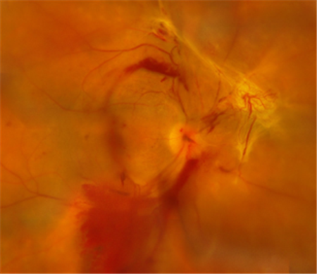 玻璃体视网膜