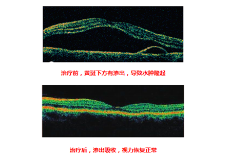 玻璃体视网膜