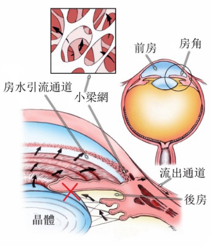 白内障