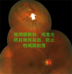 玻璃体视网膜
