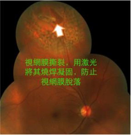 玻璃体视网膜