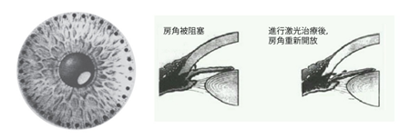 白内障