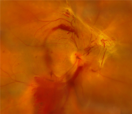 玻璃体视网膜