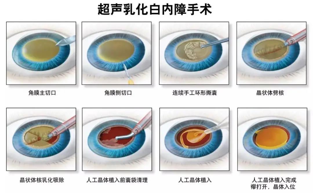 白内障