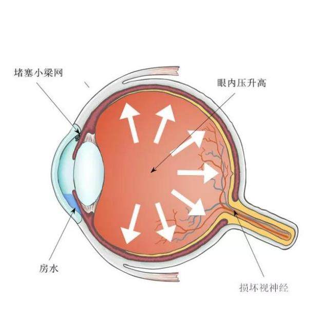 青光眼,希玛瑞视眼科,上海眼科医院