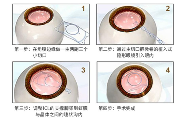 屈光矫视