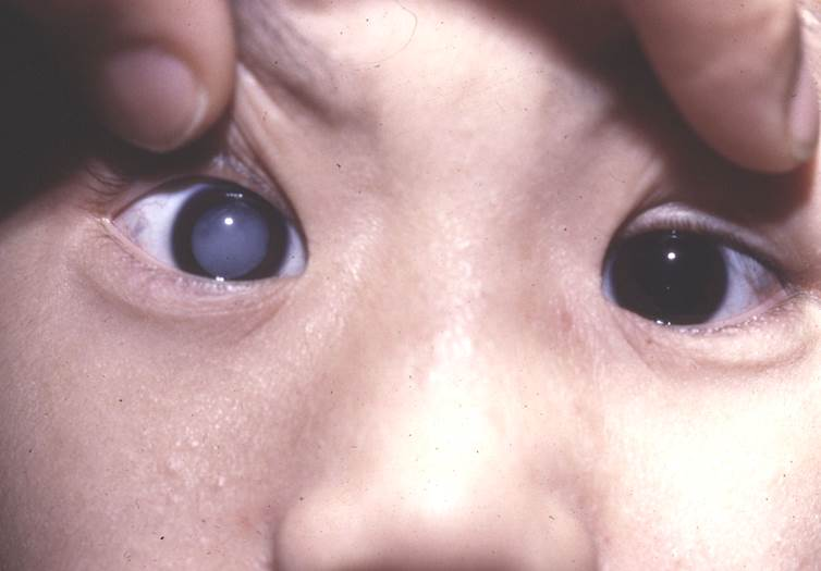 小儿眼病,希玛瑞视眼科,上海眼科医院