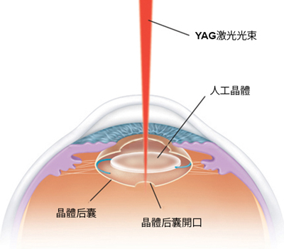 玻璃体视网膜