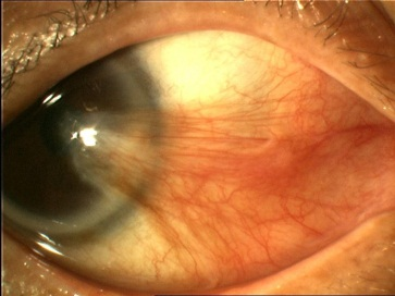 眼表眼角膜