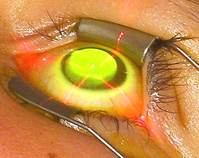 眼表眼角膜