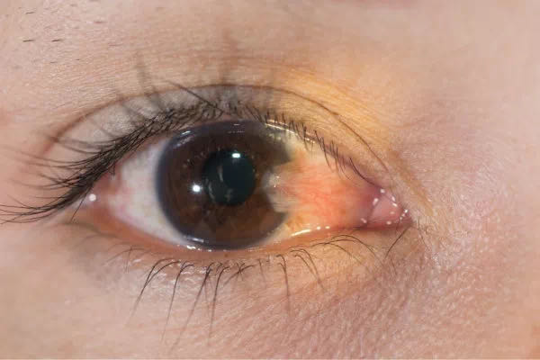 上海眼科治疗翼状胬肉比较好的医院